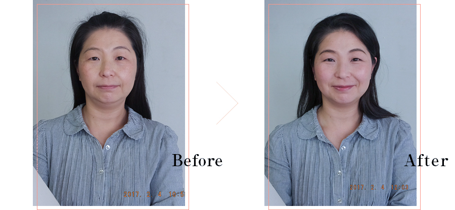 before after hikariya beauty